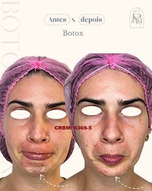 cópia de antes x depois 4 botox otimizado
