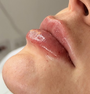 preenchimento labial indaiatuba otimizado
