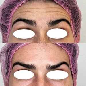 12 BOTOX (2)