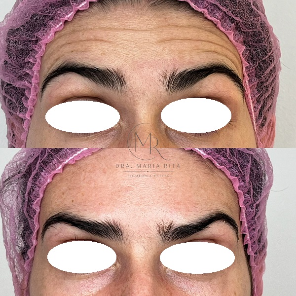 12 BOTOX (2)