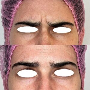 11 BOTOX (3)