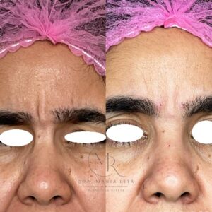9 BOTOX (5)