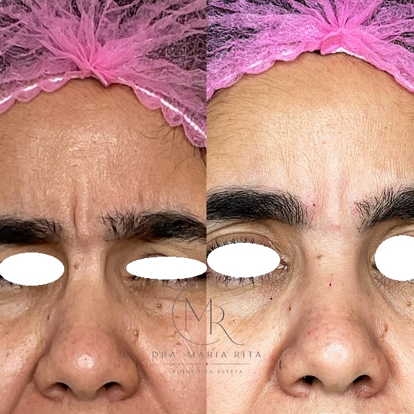 9 BOTOX (5)