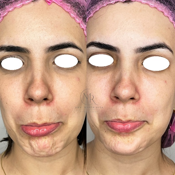 7 BOTOX444