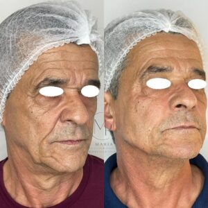 5 PERFILOPLASTIA 5