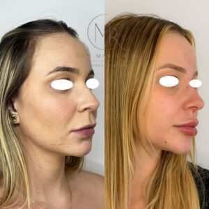 4 perfiloplastia